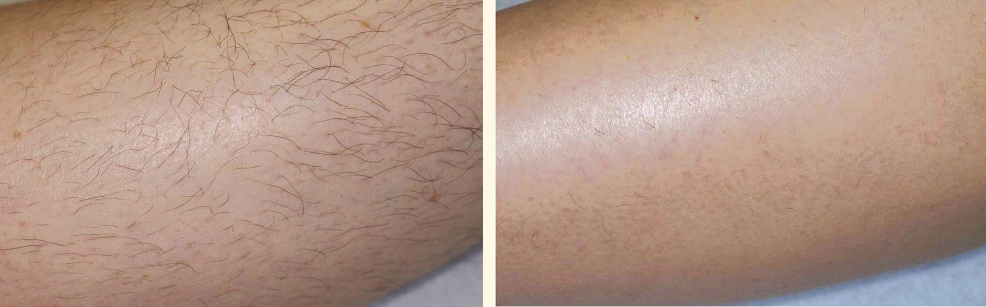 Depilación IPL de Brazos - Clínica Estética Carvajal Panamá 2