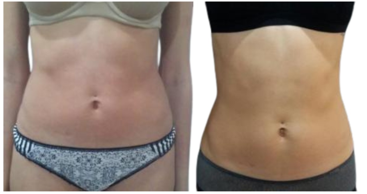Lipolaser Contourning - Clínica Estética Carvajal Panamá 3