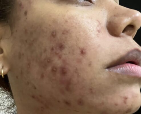 Melas Peel - Clínica Estética Carvajal Panamá 7