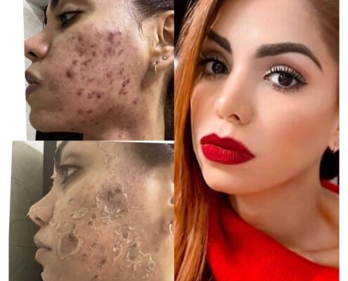 Melas Peel - Clínica Estética Carvajal Panamá 9