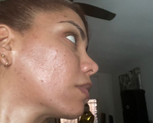 Melas Peel - Clínica Estética Carvajal Panamá 5