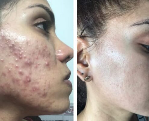 Melas Peel - Clínica Estética Carvajal Panamá 8