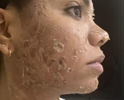 Melas Peel - Clínica Estética Carvajal Panamá 6
