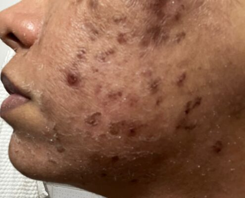 Melas Peel - Clínica Estética Carvajal Panamá 2