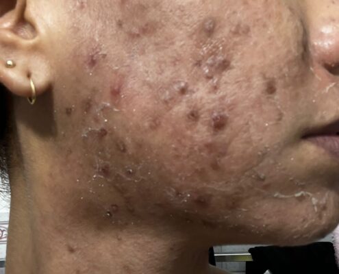 Melas Peel - Clínica Estética Carvajal Panamá 4