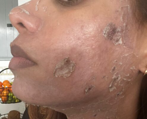 Melas Peel - Clínica Estética Carvajal Panamá 3
