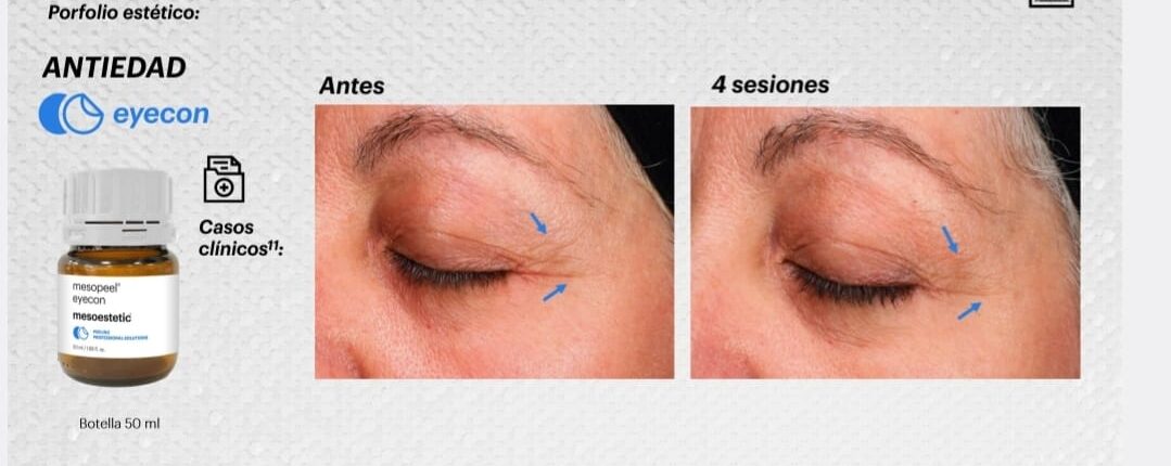 Peeling Periocular Mesoestetic - Clínica Estética Carvajal Panamá 2