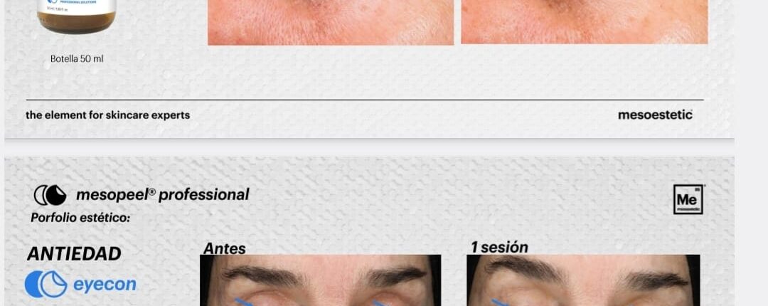 Peeling Periocular Mesoestetic - Clínica Estética Carvajal Panamá 3
